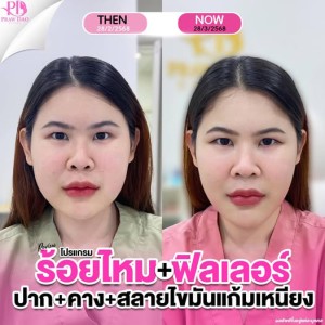 สินค้า ประกาศ ยกกระชับ อุดร-ฉีดโบท็อก ฉีดฟิลเลอร์อุดรธานี ลดริ้วรอย เสริมความงามอุด